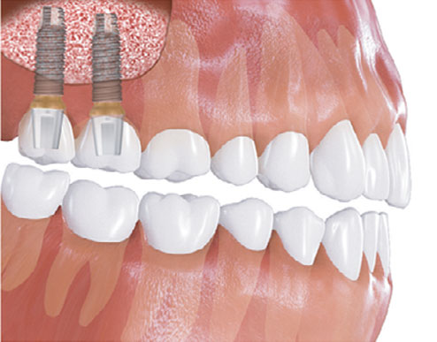 Maxillary sinus