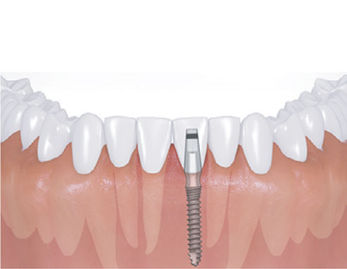 Implant for the narrow gap between teeth