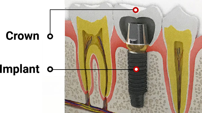 Diagram of dental implant