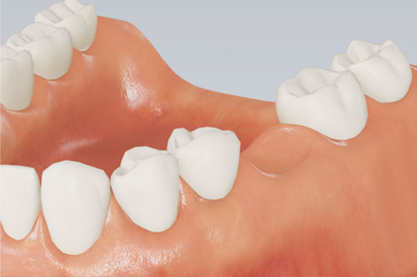 Model showing missing tooth
