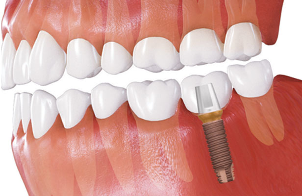 Diagram of implant after treatment