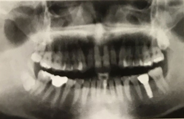 Radiograph after the treatment