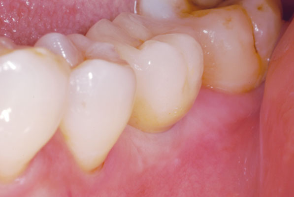 Molar tooth after treatment