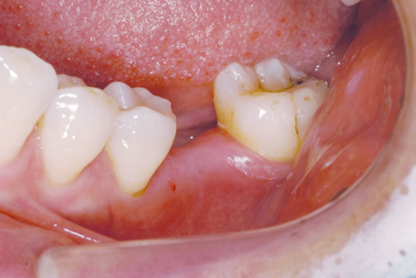 Molar tooth before the treatment