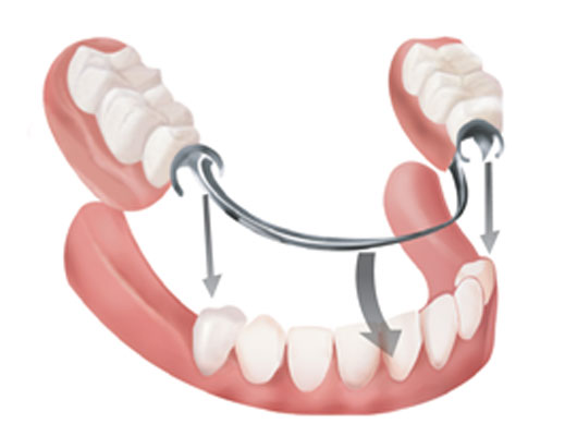 Model of removable partial denture